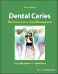 Dental Caries The Disease and its Clinical Management (Color)