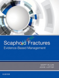 Scaphoid Fractures: Evidence-Based Management (Color)