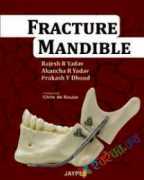 Fracture Mandible