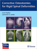 Corrective Osteotomies for Rigid Spinal Deformities (Color)